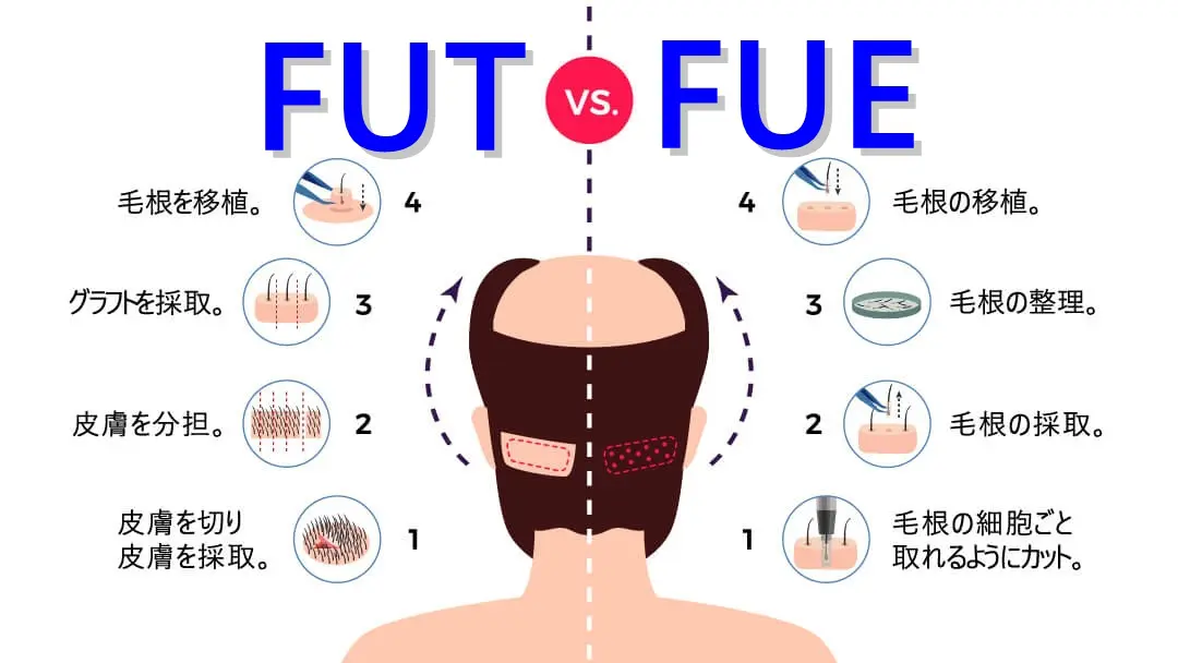 植毛のスーパードクター・フラッド先生に聞いてみた～日本の植毛ブログ