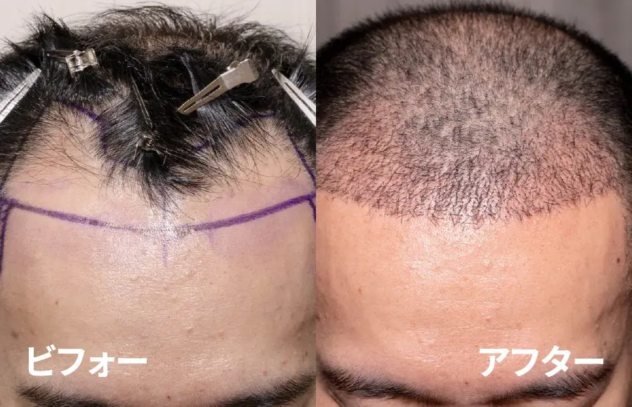 植毛のスーパードクター・フラッド先生に聞いてみた～海外植毛