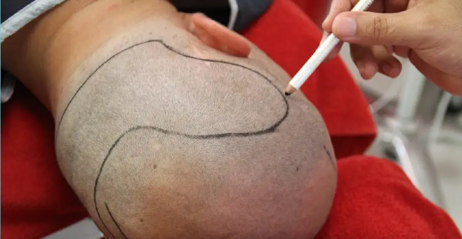 植毛完全ガイド : 世界のスタンダードFUT治療の流れ : 最新版 メガセッション（大量植毛）でFUTは一度に1,800株まで可能だが