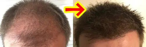 植毛のスーパードクター・フラッド先生に聞いてみた～海外植毛