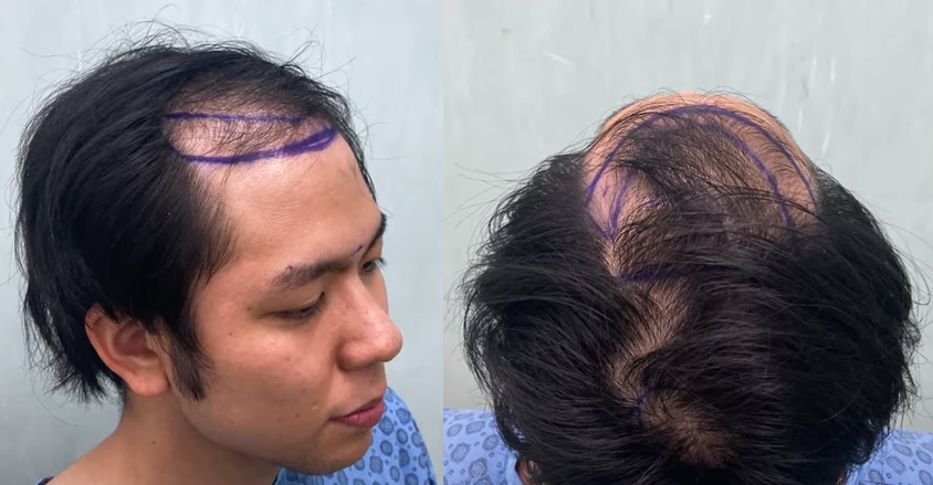 新社会人の人生を変える最先端植毛！～これから新社会人になる九州出身