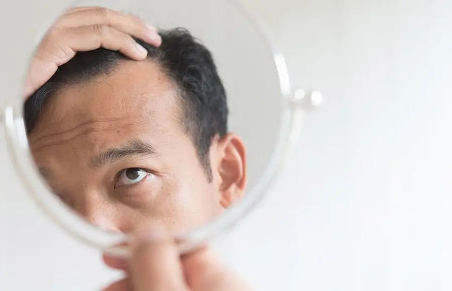 植毛のスーパードクター・フラッド先生に聞いてみた～海外植毛