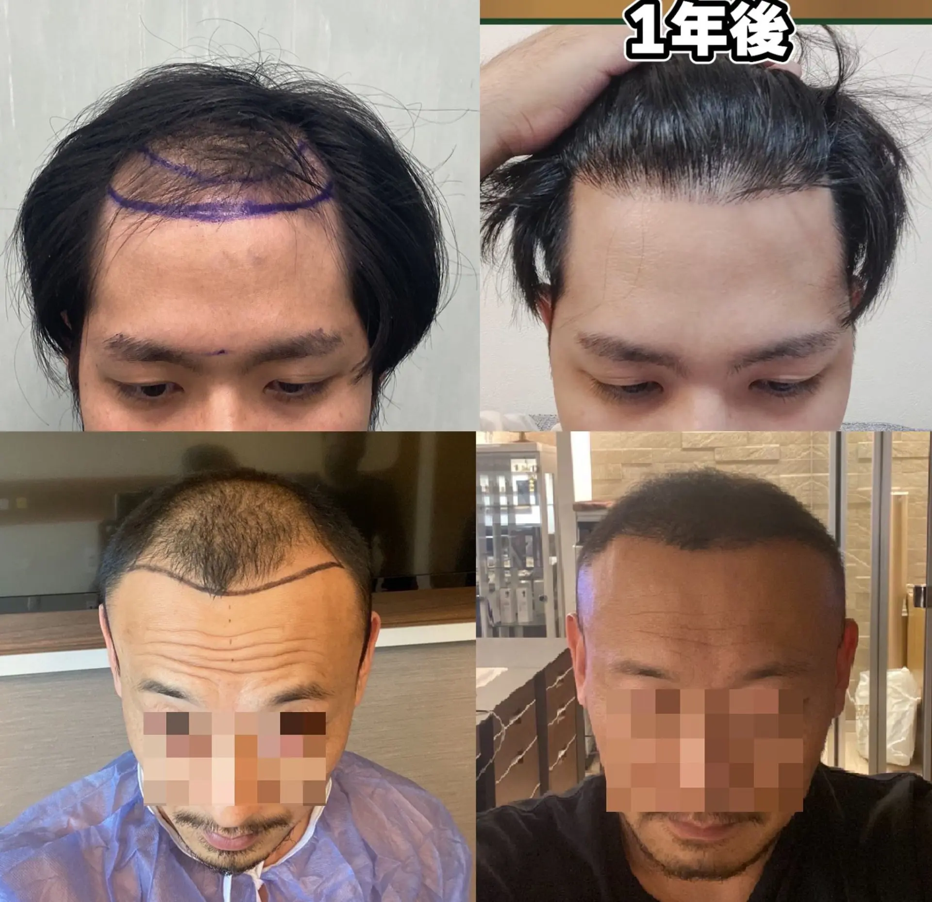hair-transplant-before-and-