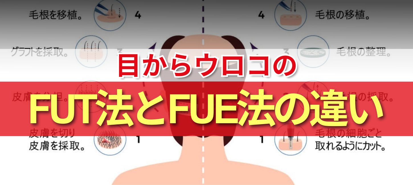 自毛植毛FUTとFUE、DHI法の違いを「世界一分かりやすく」徹底解説して