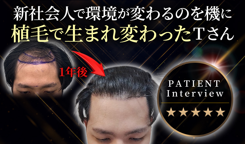 Dr.今川の植毛体験記 専門医が自分の髪で実践したドキュメント 最先端の自毛植… hq720.jpg?sqp=-
